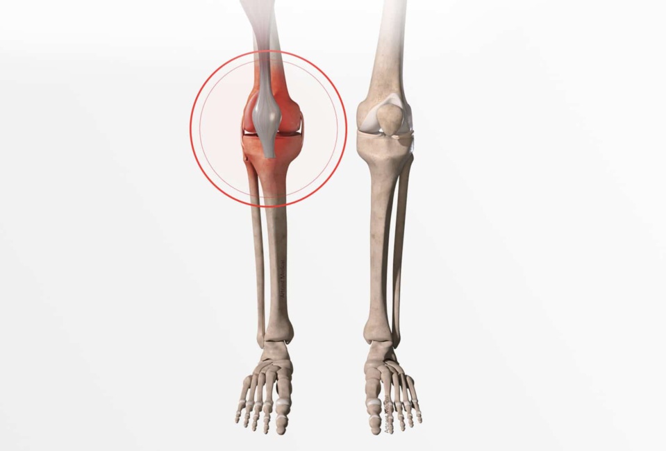 UNE DAME DE 51 ANS MEURT À FASS 24 JOURS APRES UNE BOUSCULADE AVEC SA VOISINE: Pour une histoire de robinet, Fanta Djiba avait grièvement blessé Ndioba Guèye en lui occasionnant deux fractures à la cheville et à la hanche UNE DAME DE 51 ANS MEURT À FASS 24 JOURS APRES UNE BOUSCULADE AVEC SA VOISINE: Pour une histoire de robinet, Fanta Djiba avait grièvement blessé Ndioba Guèye en lui occasionnant deux fractures à la cheville et à la hanche