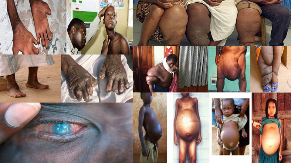 Le Sénégal, un pays endémique à 14 maladies tropicales négligées