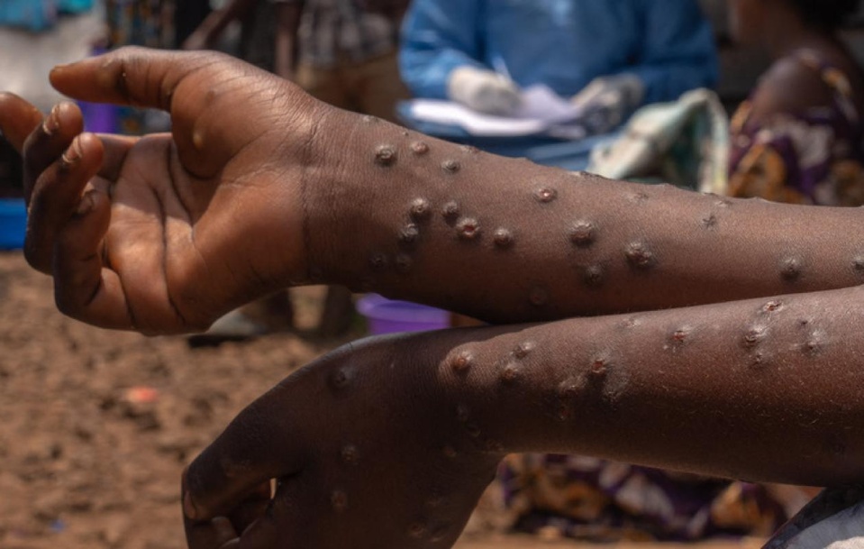 Mpox : le cas importé guéri Mpox : le cas importé guéri