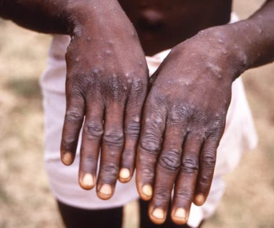 VARIOLE DU SINGE, FIÈVRE DE LA VALLÉE DU RIFT ET SANTÉ PUBLIQUE EN PÉRIL : And Gueusseum prévient sur les épidémies, la gestion «illégale» des patients référés et menace de déterrer la hache de guerre
