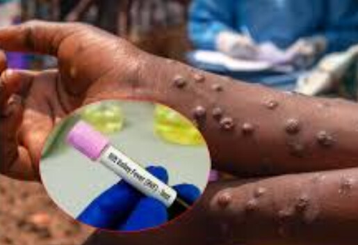 Fièvre de la vallée du Rift : un cas enregistré à Dakar