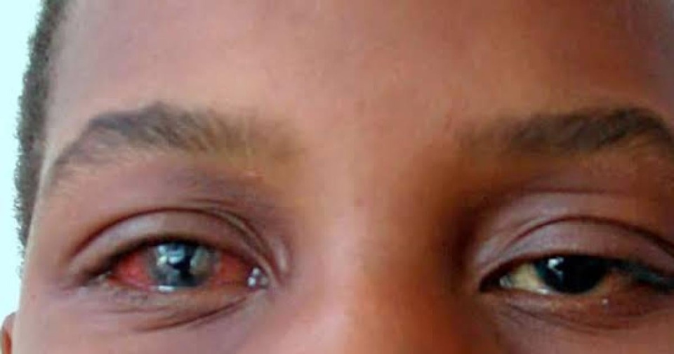 ALERTE CONJONCTIVITE À DAKAR : La flambée des « yeux rouges » communément appelés « Appolo » gagne du terrain à une vitesse V
