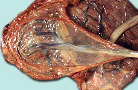 interruption volontaire de grossesse  Awa Aïssatou Diop expulse un fœtus de 5 mois, coupe le cordon ombilical avec un couteau puis met le cadavre dans un sachet et le jette à la plage