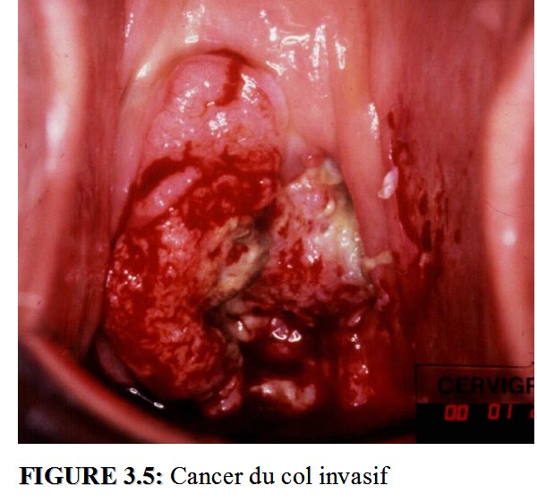 LUTTE CONTRE LE CANCER DU COL DE L’UTÉRUS À ZIGUINCHOR : 8 thermoablations et 802 coloscopies pratiquées avec 6 cas de suspension de cancers…