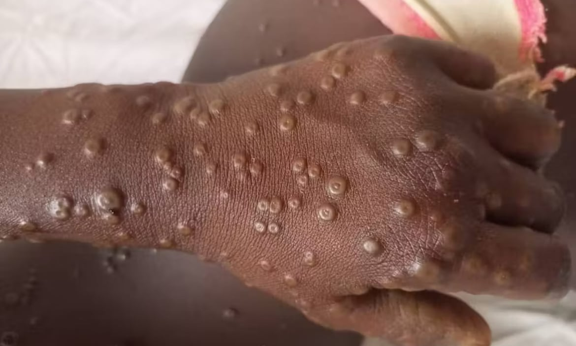 Mpox : le Sénégal enregistre un 2e cas confirmé