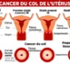 LUTTE CONTRE LE CANCER DU COL DE L’UTERUS 1800 nouveaux cas de cancer par an au Sénégal, la Lisca préconise le dépistage des femmes de 40 et 74 ans tous les 2 ans