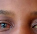 ALERTE CONJONCTIVITE À DAKAR : La flambée des « yeux rouges » communément appelés « Appolo » gagne du terrain à une vitesse V