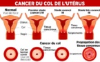LUTTE CONTRE LE CANCER DU COL DE L’UTERUS 1800 nouveaux cas de cancer par an au Sénégal, la Lisca préconise le dépistage des femmes de 40 et 74 ans tous les 2 ans