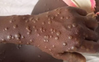 SITUATION DU MPOX ( VARIOLE DU SINGE) : Deux nouveaux cas positifs confirmés sur les 42 cas contacts