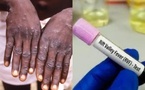 Fièvre de la vallée du Rift et Mpox :  les révélations du ministère de la Santé