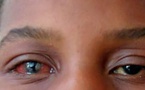 ALERTE CONJONCTIVITE À DAKAR : La flambée des « yeux rouges » communément appelés « Appolo » gagne du terrain à une vitesse V