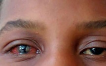 ALERTE CONJONCTIVITE À DAKAR : La flambée des « yeux rouges » communément appelés « Appolo » gagne du terrain à une vitesse V